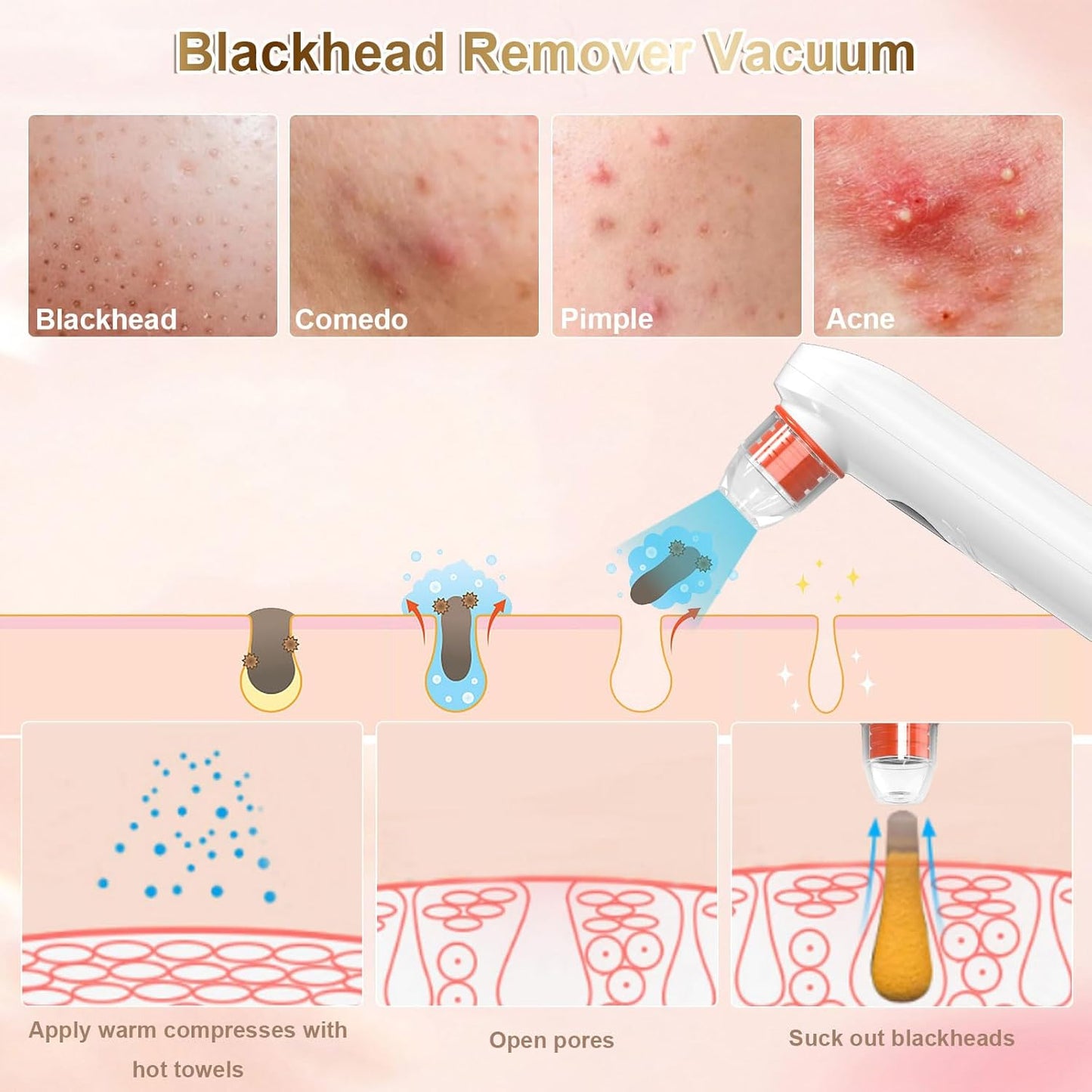 UGlow™ - HD Blackhead Remover-Pore Vacuum